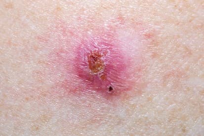 pinnacleskin.com /conditions/basal-cell-carcinoma Carousel 1 Image 7